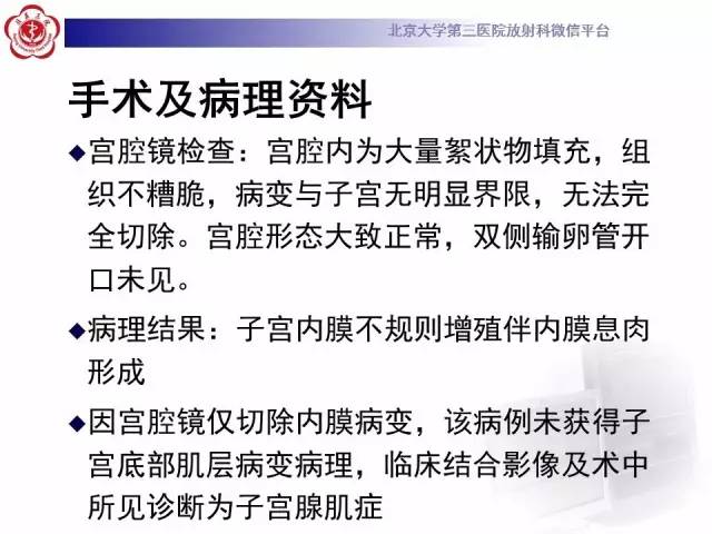 【病例】子宫内膜息肉2例MR影像诊断