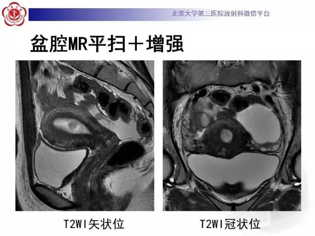 【病例】子宫内膜息肉2例MR影像诊断