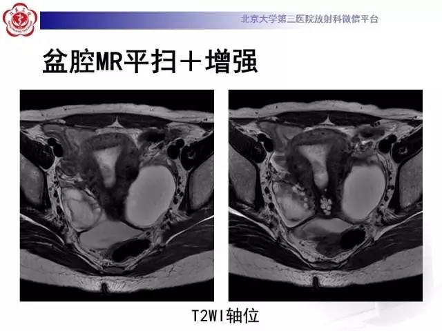 【病例】子宫内膜息肉2例MR影像诊断
