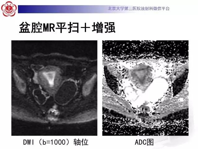 【病例】子宫内膜息肉2例MR影像诊断