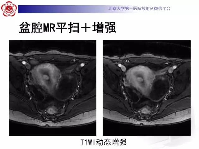 【病例】子宫内膜息肉2例MR影像诊断