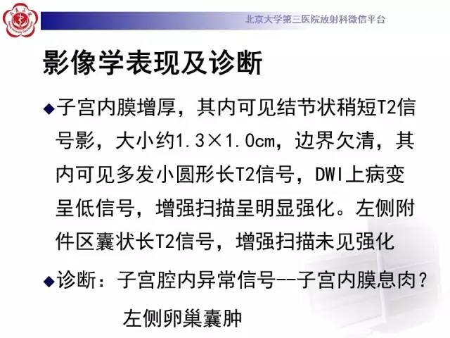 【病例】子宫内膜息肉2例MR影像诊断