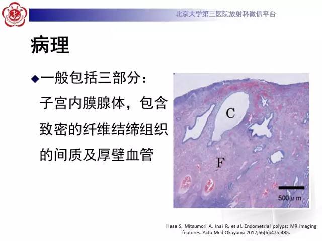 【病例】子宫内膜息肉2例MR影像诊断