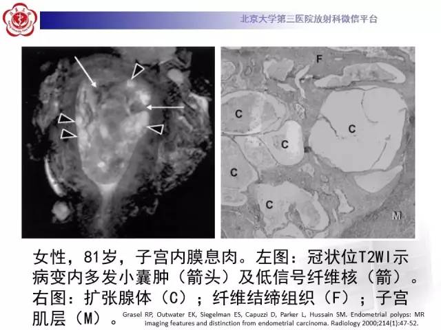 【病例】子宫内膜息肉2例MR影像诊断