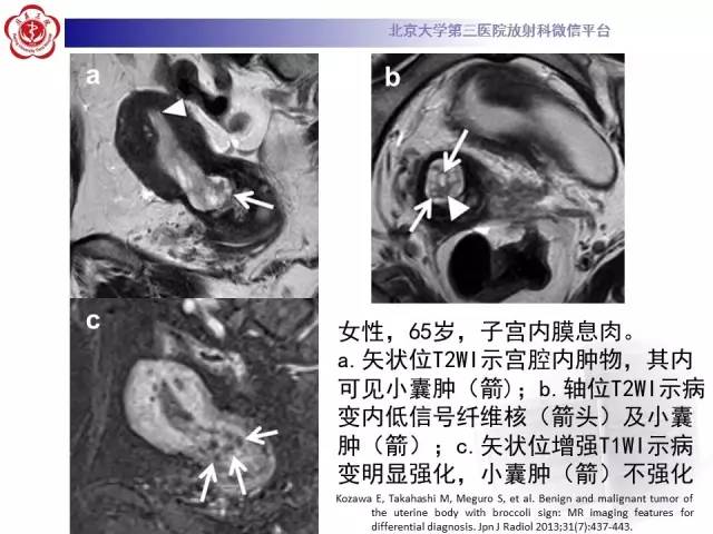 【病例】子宫内膜息肉2例MR影像诊断
