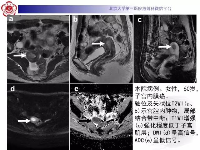 【病例】子宫内膜息肉2例MR影像诊断