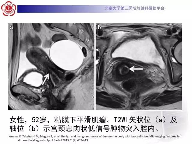 【病例】子宫内膜息肉2例MR影像诊断