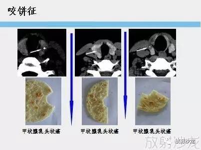 甲状腺乳头状癌的CT征象之咬饼征四例 甲状腺乳头状癌的CT征象之咬饼征四例