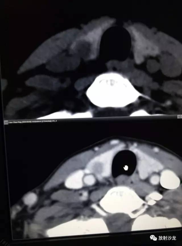 甲状腺乳头状癌的CT征象之咬饼征四例 甲状腺乳头状癌的CT征象之咬饼征四例