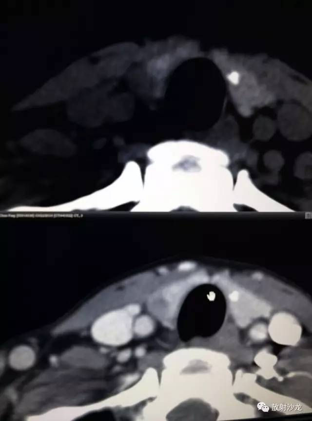 甲状腺乳头状癌的CT征象之咬饼征四例 甲状腺乳头状癌的CT征象之咬饼征四例