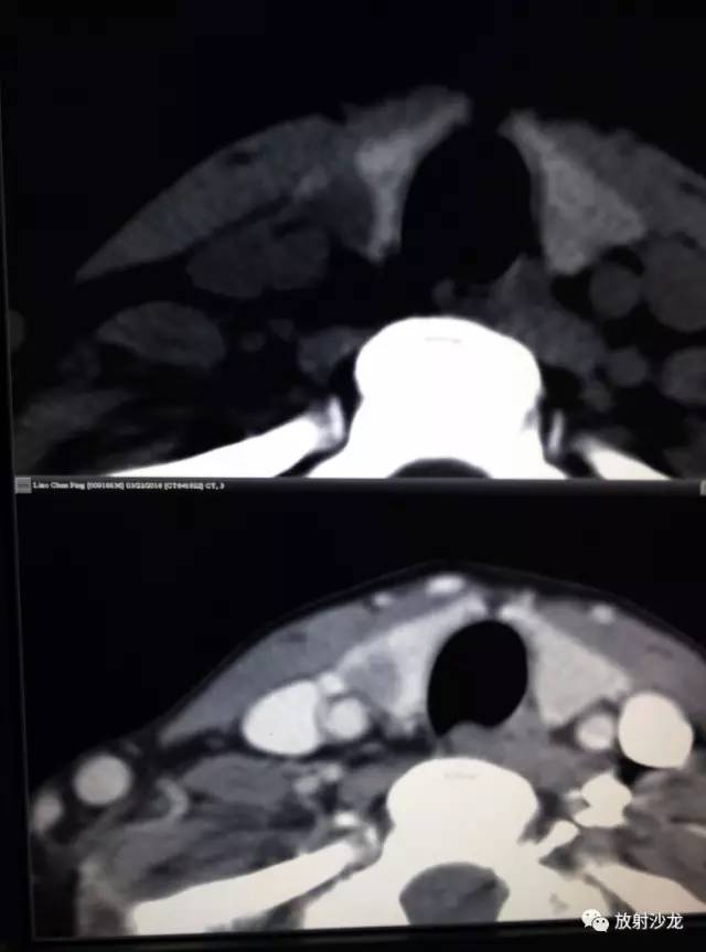 甲状腺乳头状癌的CT征象之咬饼征四例 甲状腺乳头状癌的CT征象之咬饼征四例