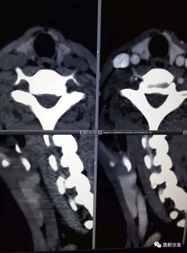 甲状腺乳头状癌的CT征象之咬饼征四例 甲状腺乳头状癌的CT征象之咬饼征四例