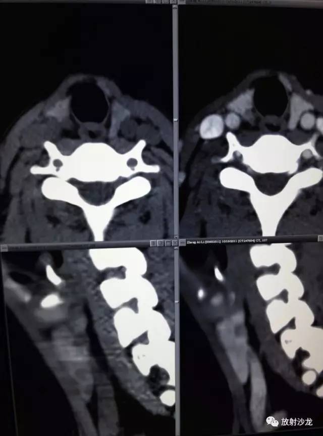 甲状腺乳头状癌的CT征象之咬饼征四例 甲状腺乳头状癌的CT征象之咬饼征四例