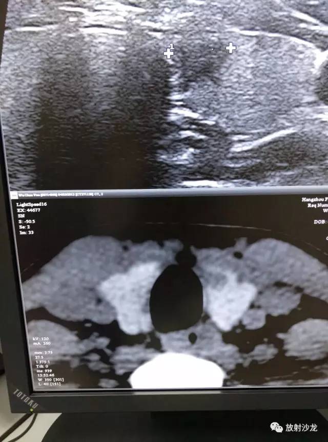 甲状腺乳头状癌的CT征象之咬饼征四例 甲状腺乳头状癌的CT征象之咬饼征四例