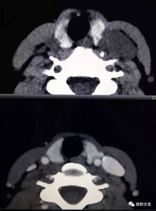 甲状腺乳头状癌的CT征象之咬饼征四例 甲状腺乳头状癌的CT征象之咬饼征四例