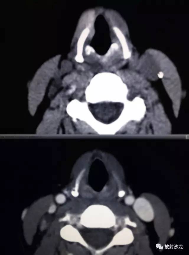 甲状腺乳头状癌的CT征象之咬饼征四例 甲状腺乳头状癌的CT征象之咬饼征四例