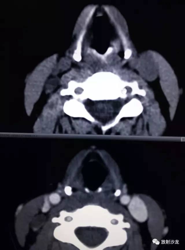 甲状腺乳头状癌的CT征象之咬饼征四例 甲状腺乳头状癌的CT征象之咬饼征四例
