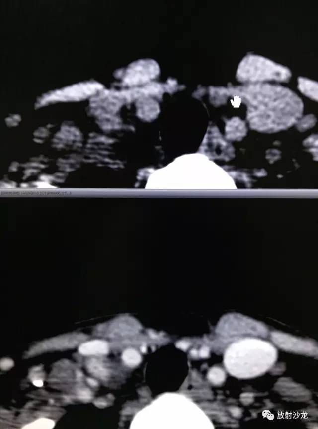 甲状腺乳头状癌的CT征象之咬饼征四例 甲状腺乳头状癌的CT征象之咬饼征四例