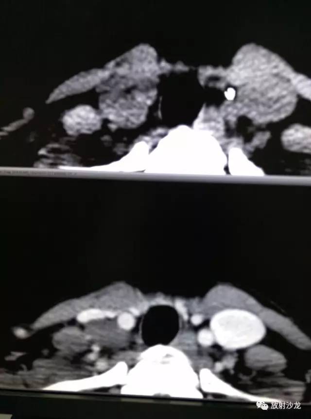 甲状腺乳头状癌的CT征象之咬饼征四例 甲状腺乳头状癌的CT征象之咬饼征四例