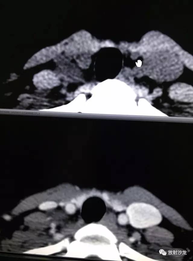 甲状腺乳头状癌的CT征象之咬饼征四例 甲状腺乳头状癌的CT征象之咬饼征四例