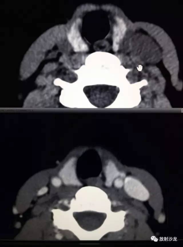 甲状腺乳头状癌的CT征象之咬饼征四例 甲状腺乳头状癌的CT征象之咬饼征四例