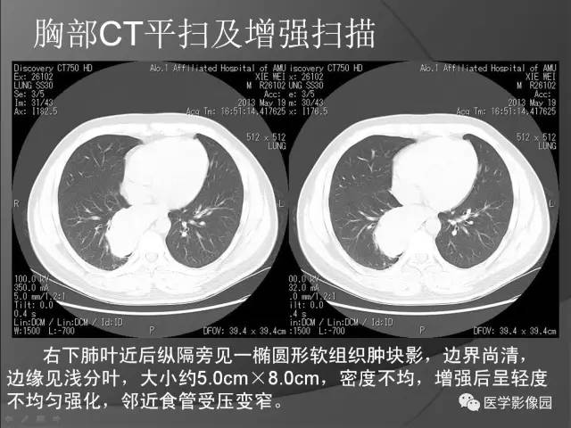 【病例】纵隔旁占位1例CT?