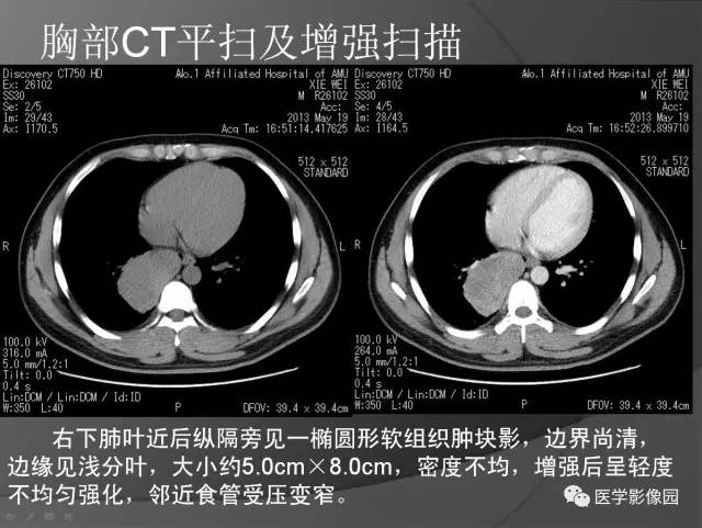 【病例】纵隔旁占位1例CT?