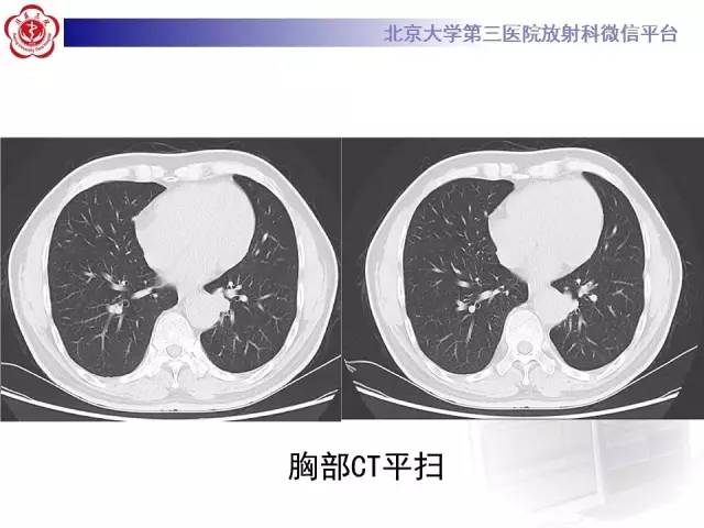 【病例】肺隔离症1例CT