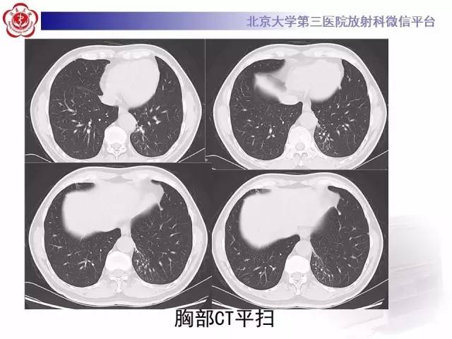【病例】肺隔离症1例CT