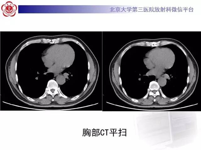 【病例】肺隔离症1例CT