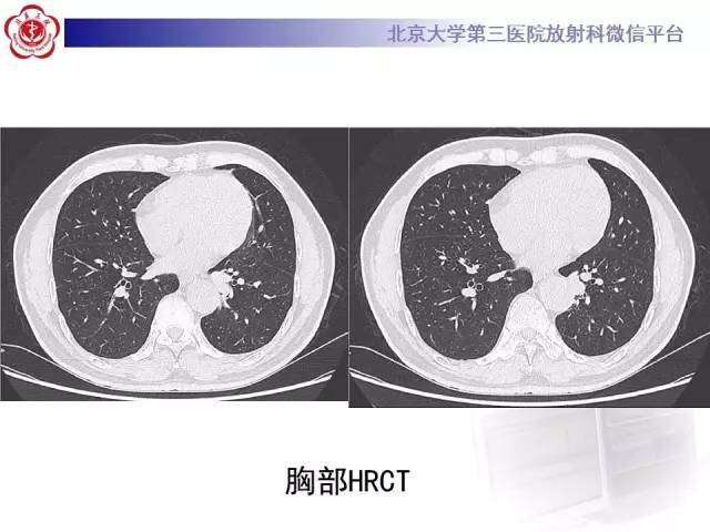 【病例】肺隔离症1例CT