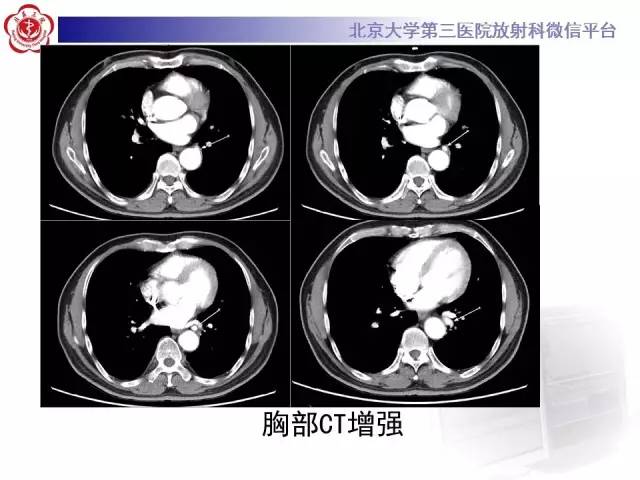 【病例】肺隔离症1例CT