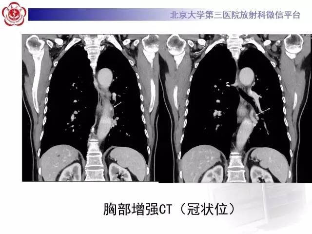 【病例】肺隔离症1例CT