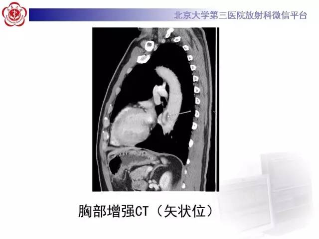 【病例】肺隔离症1例CT