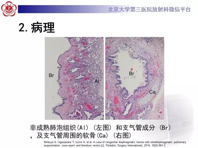 【病例】肺隔离症1例CT
