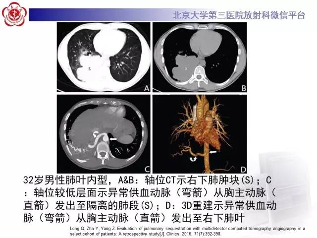【病例】肺隔离症1例CT
