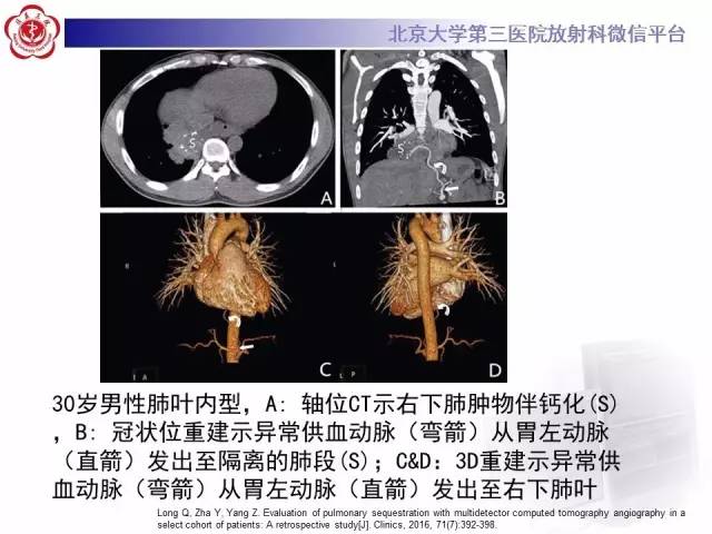 【病例】肺隔离症1例CT