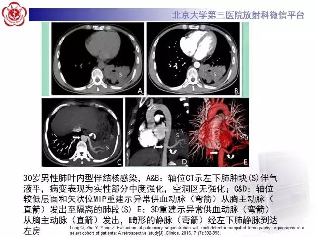 【病例】肺隔离症1例CT