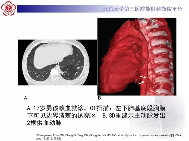【病例】肺隔离症1例CT