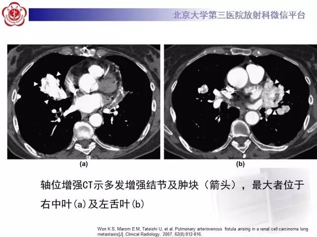 【病例】肺隔离症1例CT