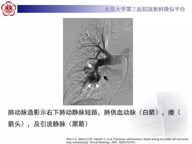 【病例】肺隔离症1例CT