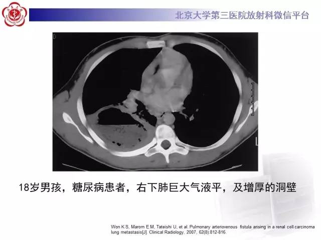 【病例】肺隔离症1例CT