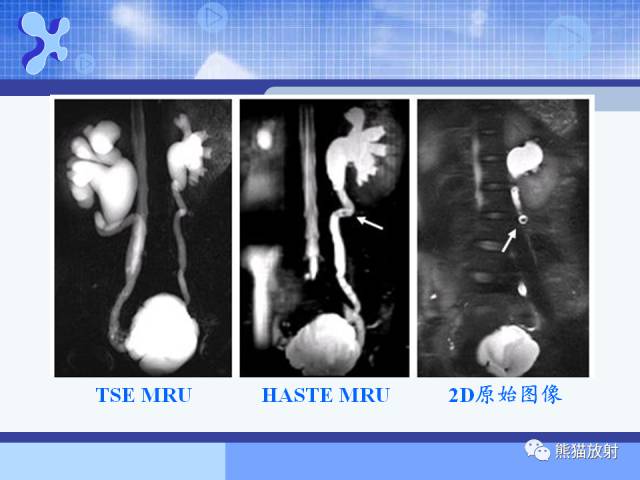 【PPT】MRU技术及临床应用 【PPT】MRU技术及临床应用