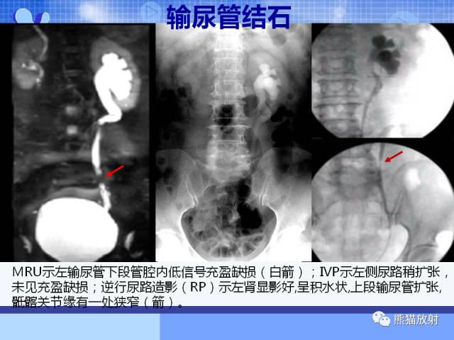 【PPT】MRU技术及临床应用 【PPT】MRU技术及临床应用
