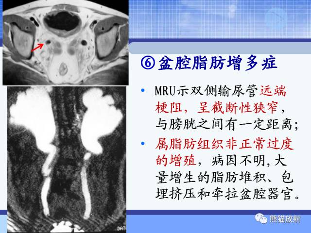 【PPT】MRU技术及临床应用 【PPT】MRU技术及临床应用