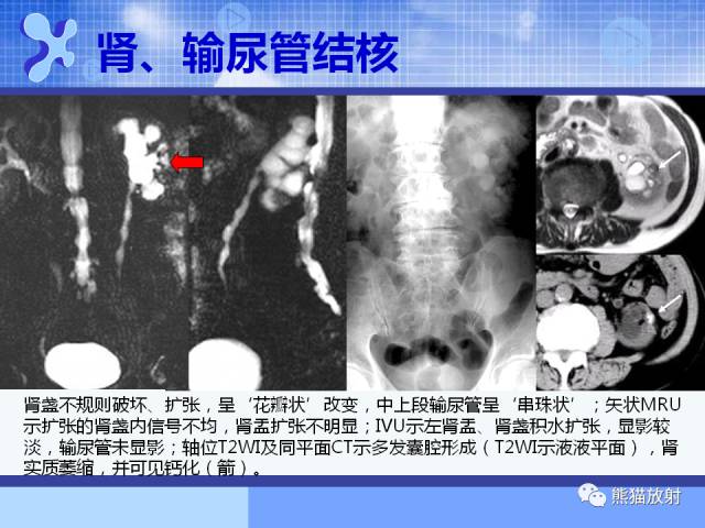 【PPT】MRU技术及临床应用 【PPT】MRU技术及临床应用