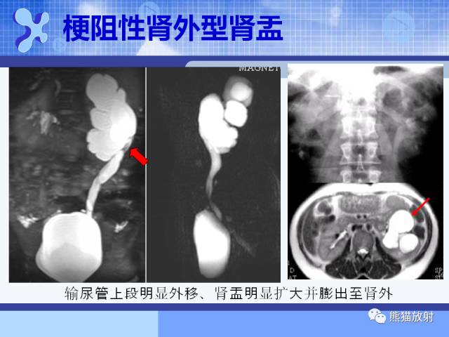 【PPT】MRU技术及临床应用 【PPT】MRU技术及临床应用