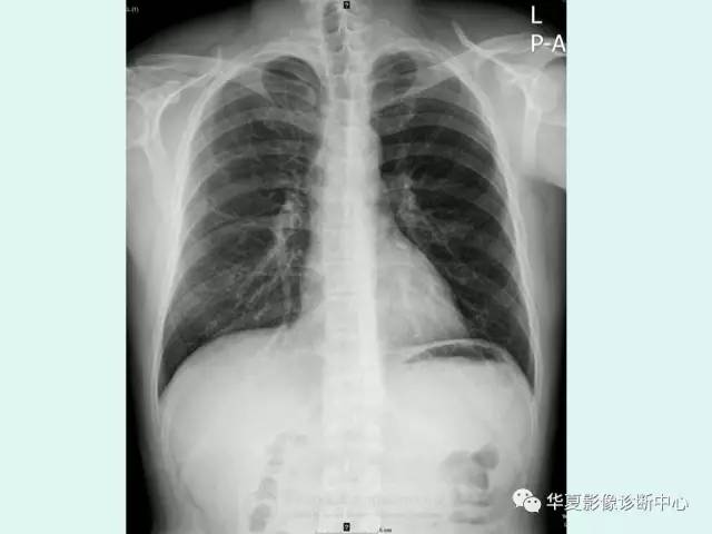 【病例】Poland综合征1例X线CT影像表现