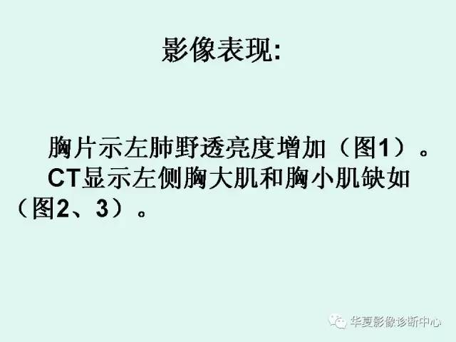 【病例】Poland综合征1例X线CT影像表现