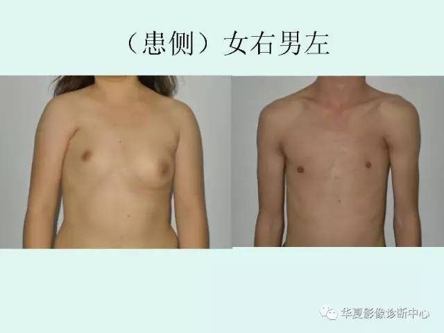 【病例】Poland综合征1例X线CT影像表现